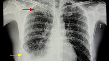 Colocación de drenaje pleural