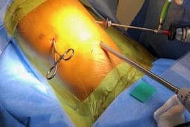 Pleurodesis