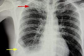 Colocación de drenaje pleural